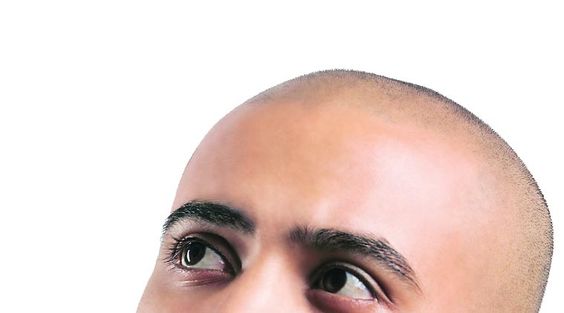 Sapphire FUE Hair Transplantation
