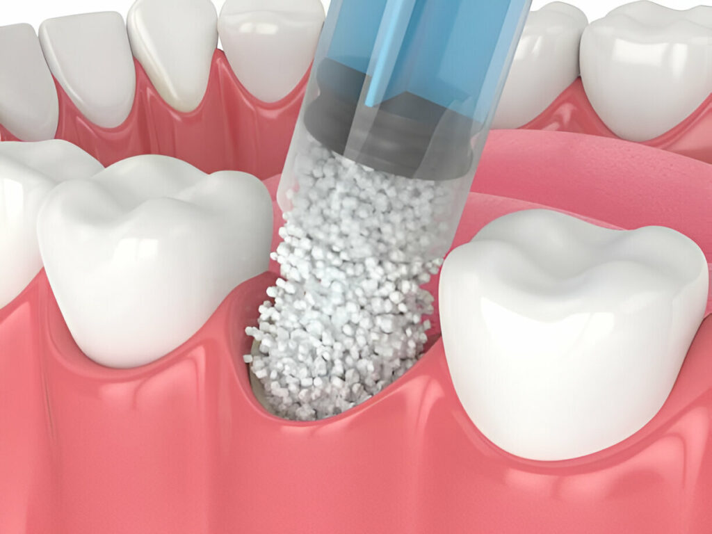 Bone Graft in Bodrum