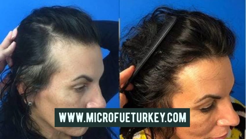 Female Hair Transplant Bodrum Marmaris Fethiye