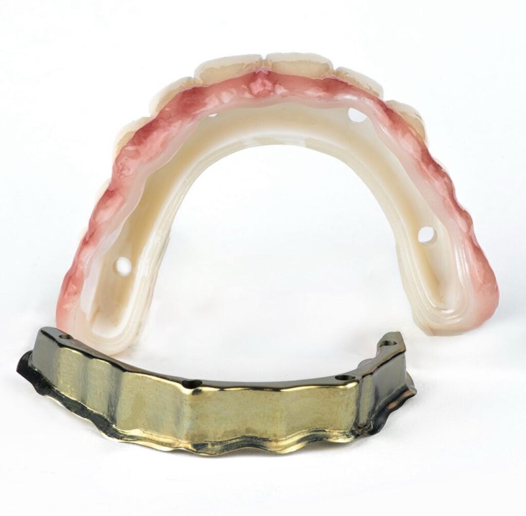 All-on-4 Implant System