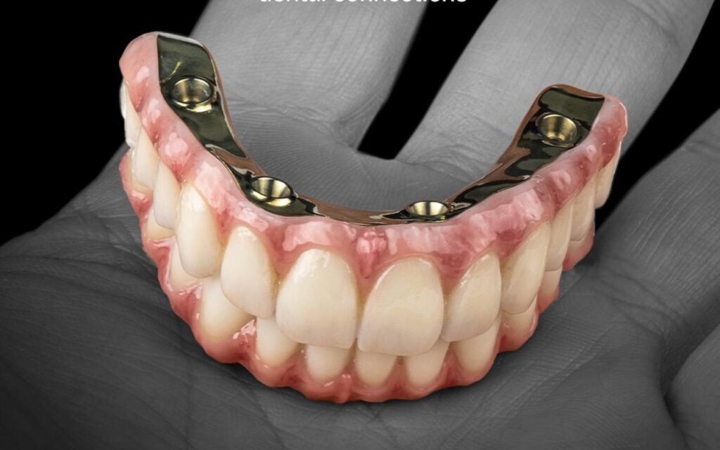 All-on-4 Implant System