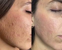 CO2 Fractional Laser in Bodrum