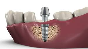 Affordable Dental Implants in Bodrum
