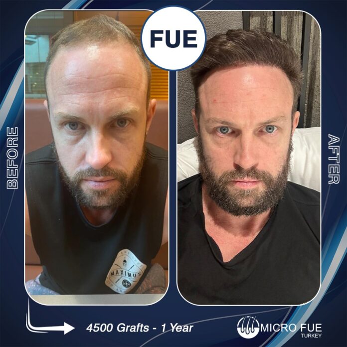 Transplant Success Rate in Turkey