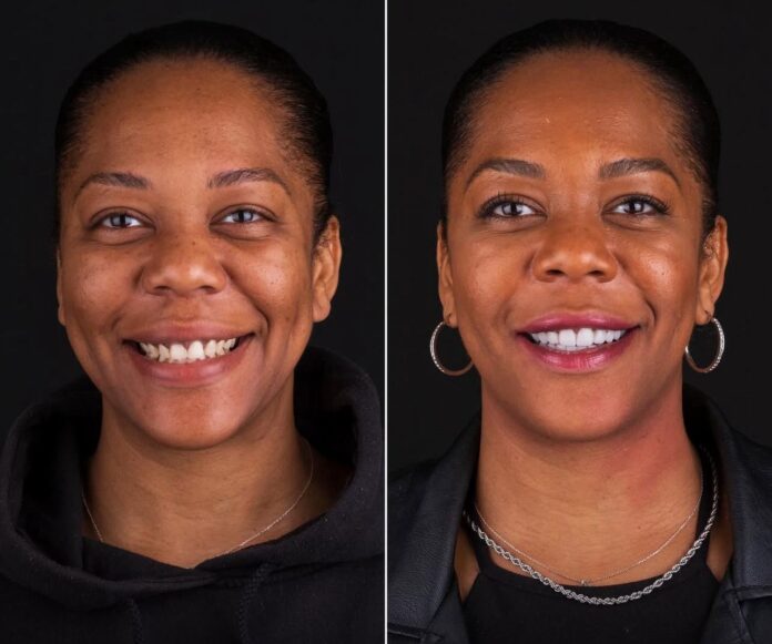 Hollywood Smile in Bodrum before and after photos showing real patient smile transformation at a Bodrum Turkey dental clinic