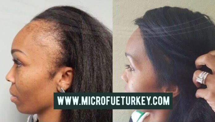 Female Hair Transplant Bodrum Marmaris Fethiye