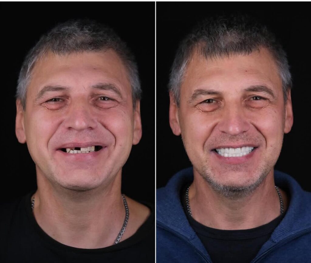 Full Mouth Dental Treatment in Bodrum