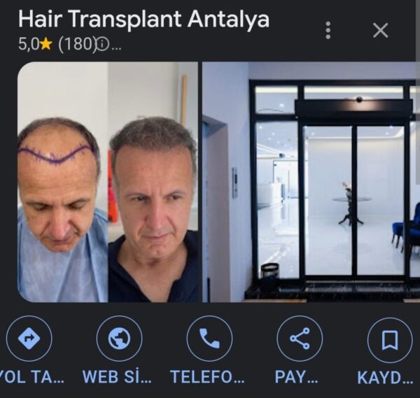 Hair Transplant in Antalya