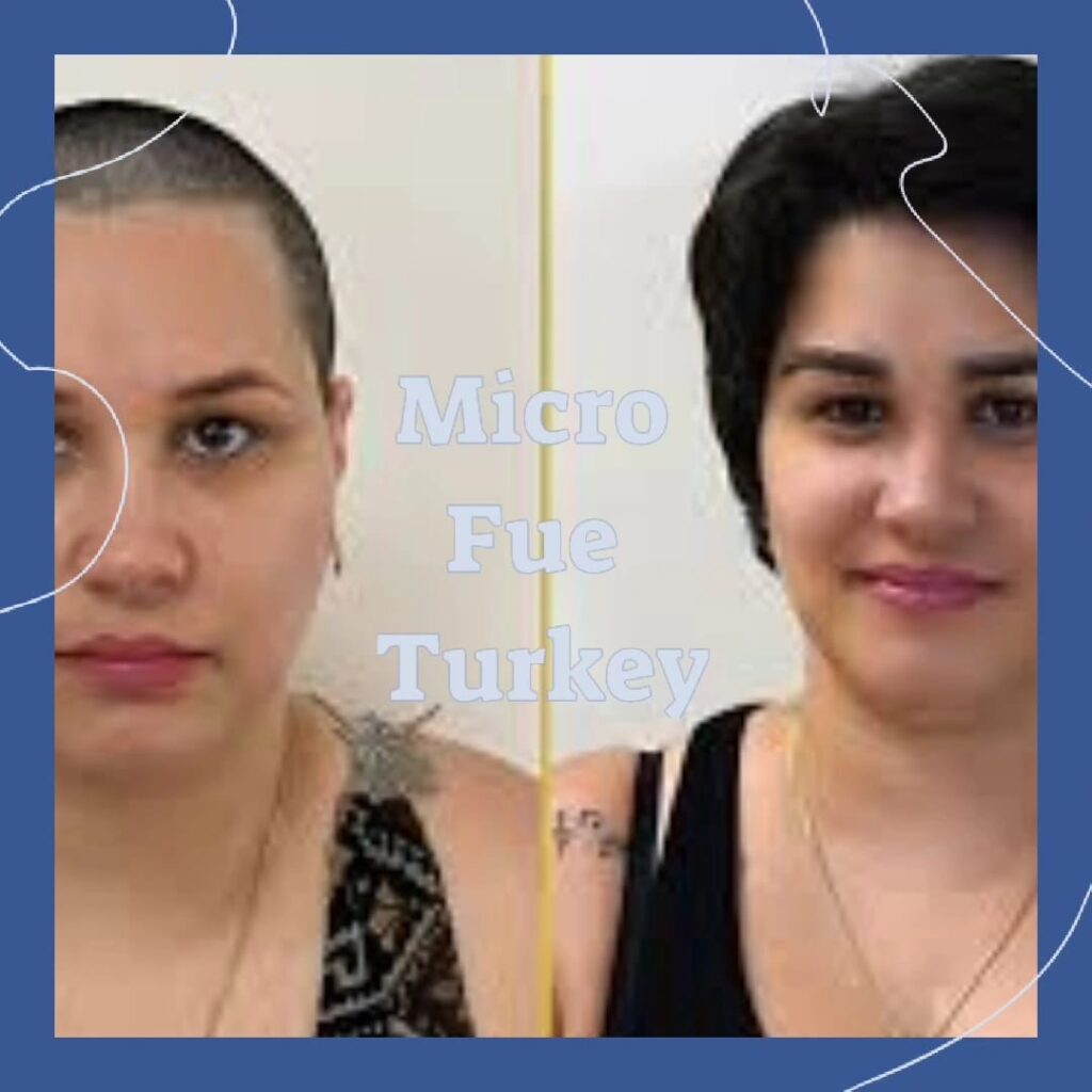 Step by Step Eyebrow Transplant Guide