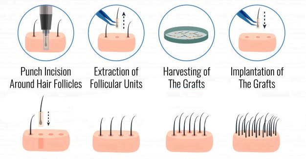 FUE Hair Transplant Method (Follicular Unit Extraction)